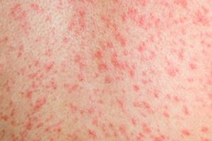 Measles Alert In Toowoomba