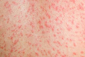 Health Unit Issues Measles Alert Health Unit Issues Measles Alert